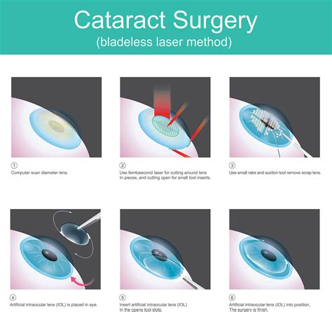 cataract surgery in huddersfield|Overview .